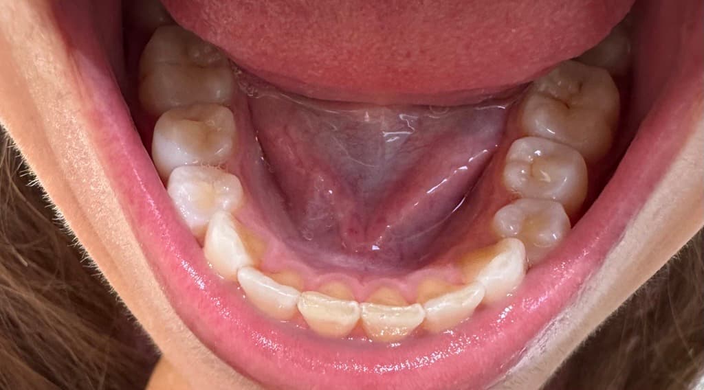 End of treatment